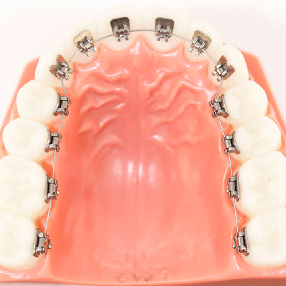 imagen de modelo pl&aacute;stico brackets superiores de ortodoncia lingual
