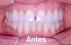 Antes de Ortodoncia Lingual"