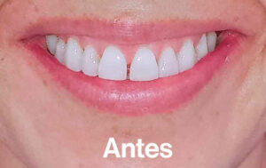 Antes de Ortodoncia Lingual"