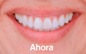 Después de Ortodoncia Lingual"