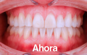 Después de Ortodoncia Lingual"