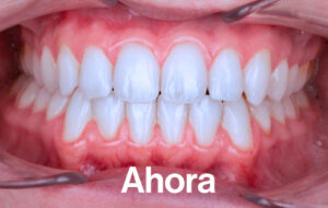 Después de Ortodoncia Lingual"