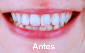 Antes de Ortodoncia Lingual"