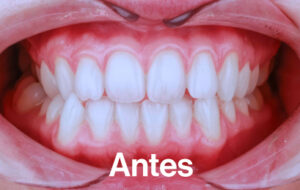 Antes de Ortodoncia Lingual"