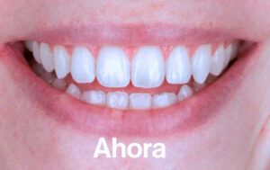 Después de Ortodoncia Lingual"