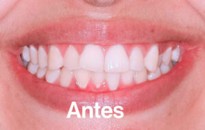 Antes de Ortodoncia Lingual"