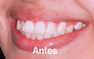 Antes de Ortodoncia Lingual"