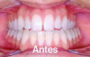 Antes de Ortodoncia Lingual"