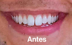 Antes de Ortodoncia Lingual"