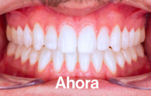 Después de Ortodoncia Lingual"