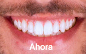 Después de Ortodoncia Lingual"